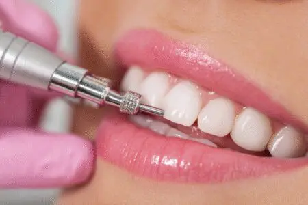 A solution for how to get rid of a gritty feeling on teeth for a smooth smile, showing a dental professional polishing teeth.